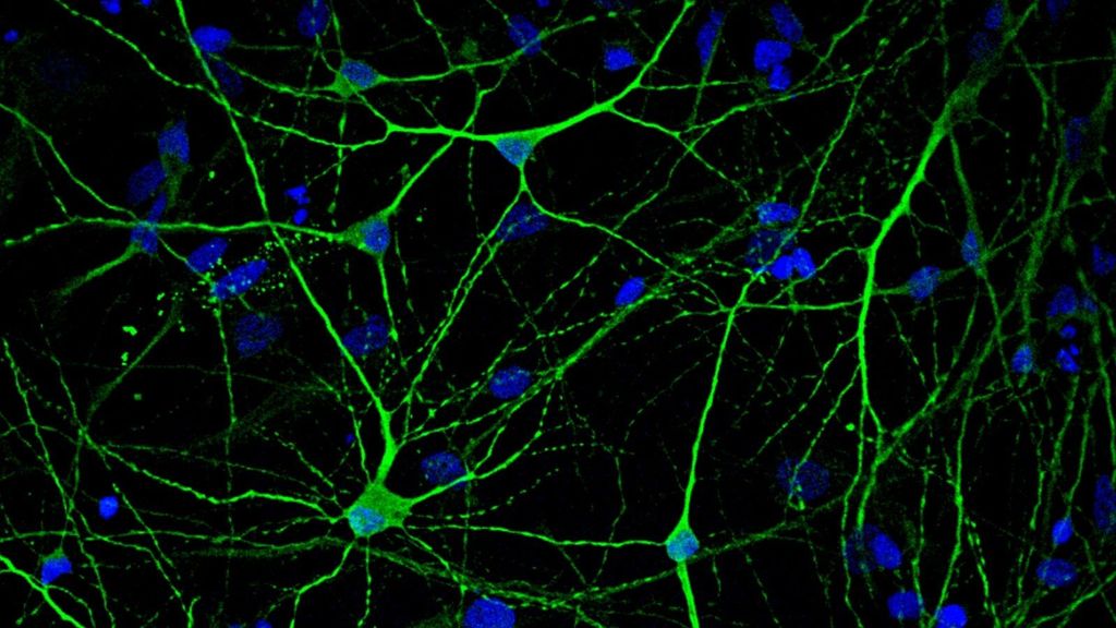 Neuronas generadas a partir de células madre de un paciente con Alzheimer